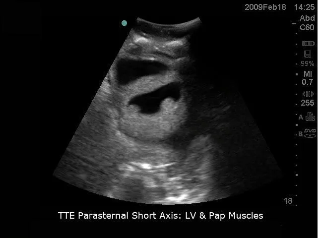 Transesophageal Echo and Transthoracic Echo Training Model